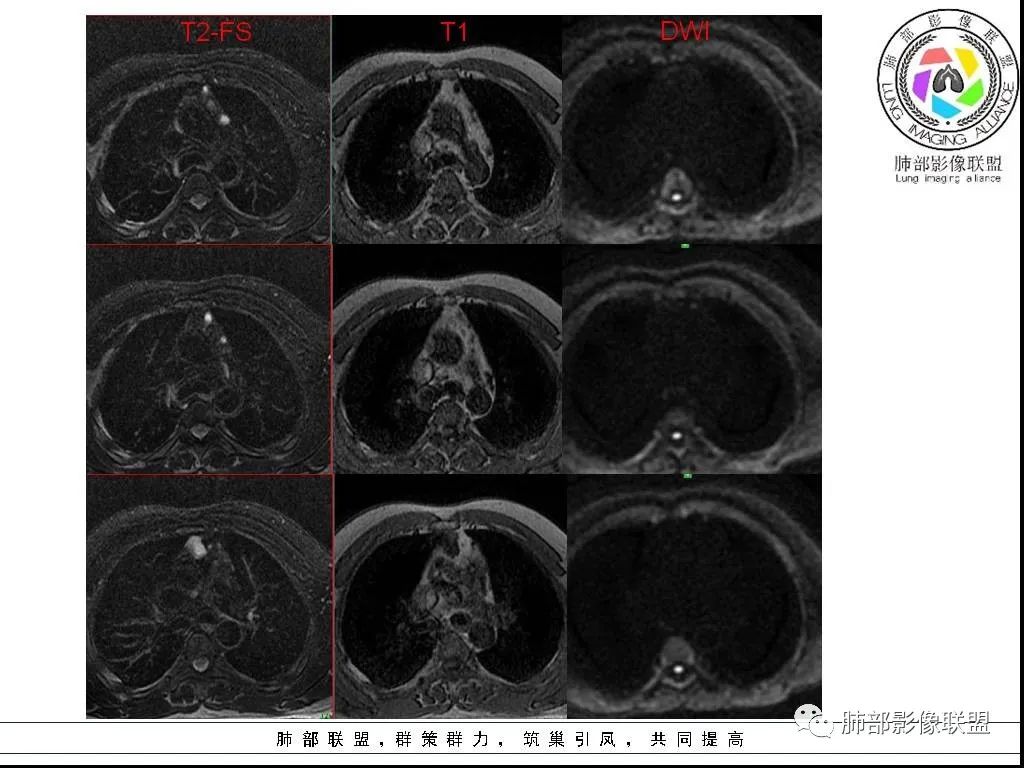 影像PPT - 【病例】前纵隔囊性肿物1例-32 影像PPT - 【病例】前纵隔囊性肿物1例-32