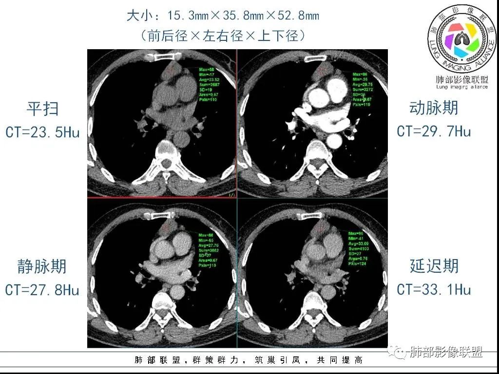 影像PPT - 【病例】前纵隔囊性肿物1例-29 影像PPT - 【病例】前纵隔囊性肿物1例-29