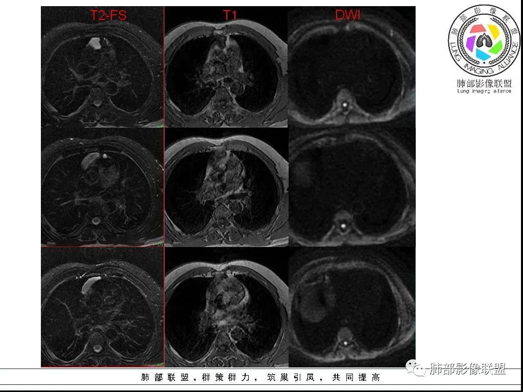 影像PPT - 【病例】前纵隔囊性肿物1例-33 影像PPT - 【病例】前纵隔囊性肿物1例-33