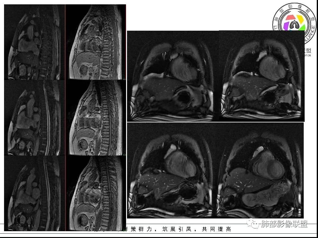 影像PPT - 【病例】前纵隔囊性肿物1例-34 影像PPT - 【病例】前纵隔囊性肿物1例-34