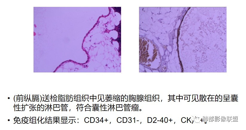 影像PPT - 【病例】前纵隔囊性肿物1例-40 影像PPT - 【病例】前纵隔囊性肿物1例-40