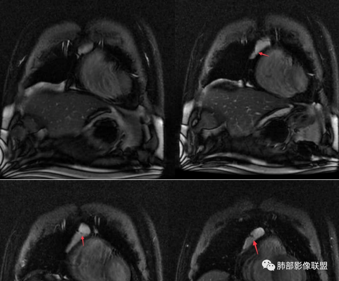 影像PPT - 【病例】前纵隔囊性肿物1例-38 影像PPT - 【病例】前纵隔囊性肿物1例-38