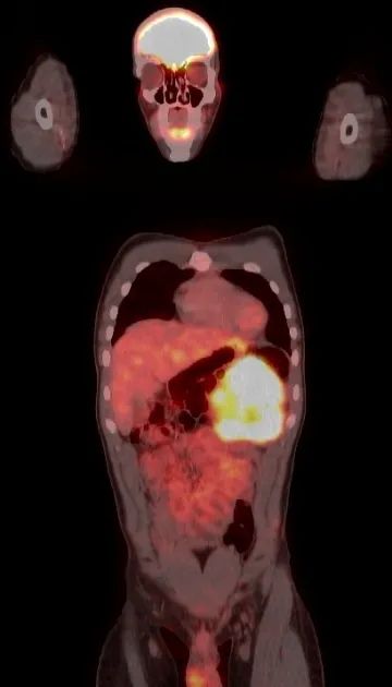 影像PPT - 【病例】腹腔促纤维增生性小圆细胞肿瘤1例PET/CT影像-9 影像PPT - 【病例】腹腔促纤维增生性小圆细胞肿瘤1例PET/CT影像-9