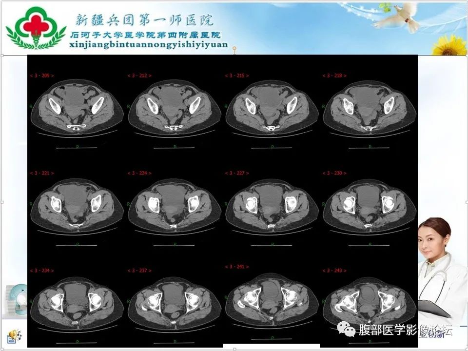 影像PPT - 【病例】卵巢纤维卵泡膜细胞瘤1例CT及MR-7 影像PPT - 【病例】卵巢纤维卵泡膜细胞瘤1例CT及MR-7