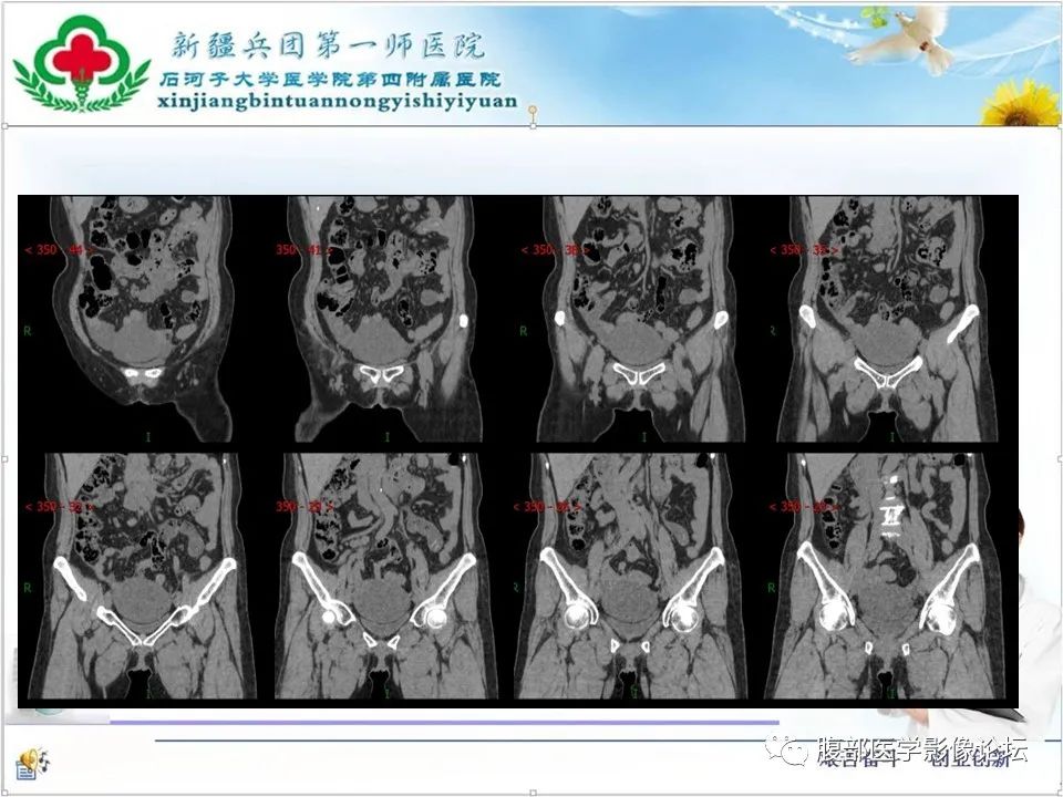 影像PPT - 【病例】卵巢纤维卵泡膜细胞瘤1例CT及MR-8 影像PPT - 【病例】卵巢纤维卵泡膜细胞瘤1例CT及MR-8