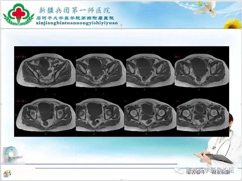 影像PPT - 【病例】卵巢纤维卵泡膜细胞瘤1例CT及MR-11 影像PPT - 【病例】卵巢纤维卵泡膜细胞瘤1例CT及MR-11