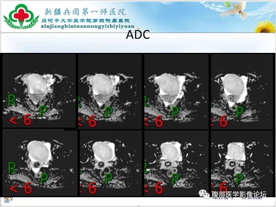 影像PPT - 【病例】卵巢纤维卵泡膜细胞瘤1例CT及MR-13 影像PPT - 【病例】卵巢纤维卵泡膜细胞瘤1例CT及MR-13