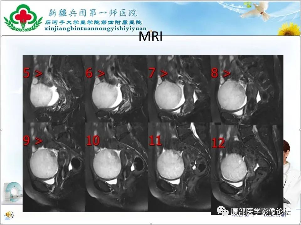 影像PPT - 【病例】卵巢纤维卵泡膜细胞瘤1例CT及MR-9 影像PPT - 【病例】卵巢纤维卵泡膜细胞瘤1例CT及MR-9