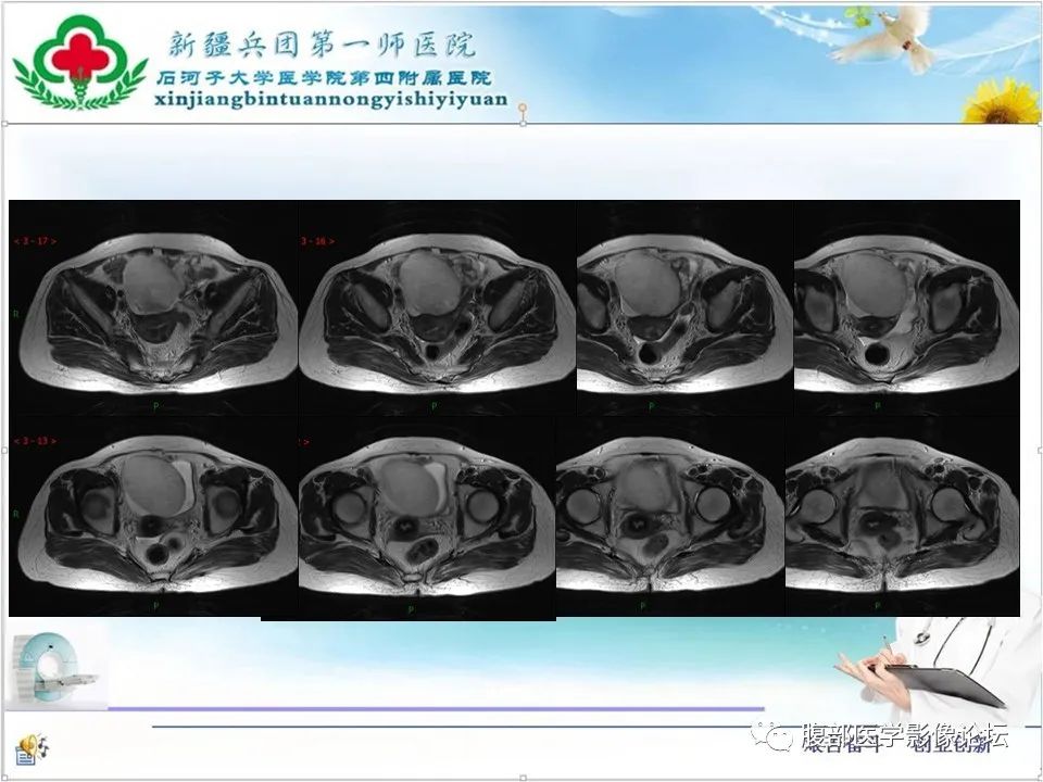 影像PPT - 【病例】卵巢纤维卵泡膜细胞瘤1例CT及MR-10 影像PPT - 【病例】卵巢纤维卵泡膜细胞瘤1例CT及MR-10