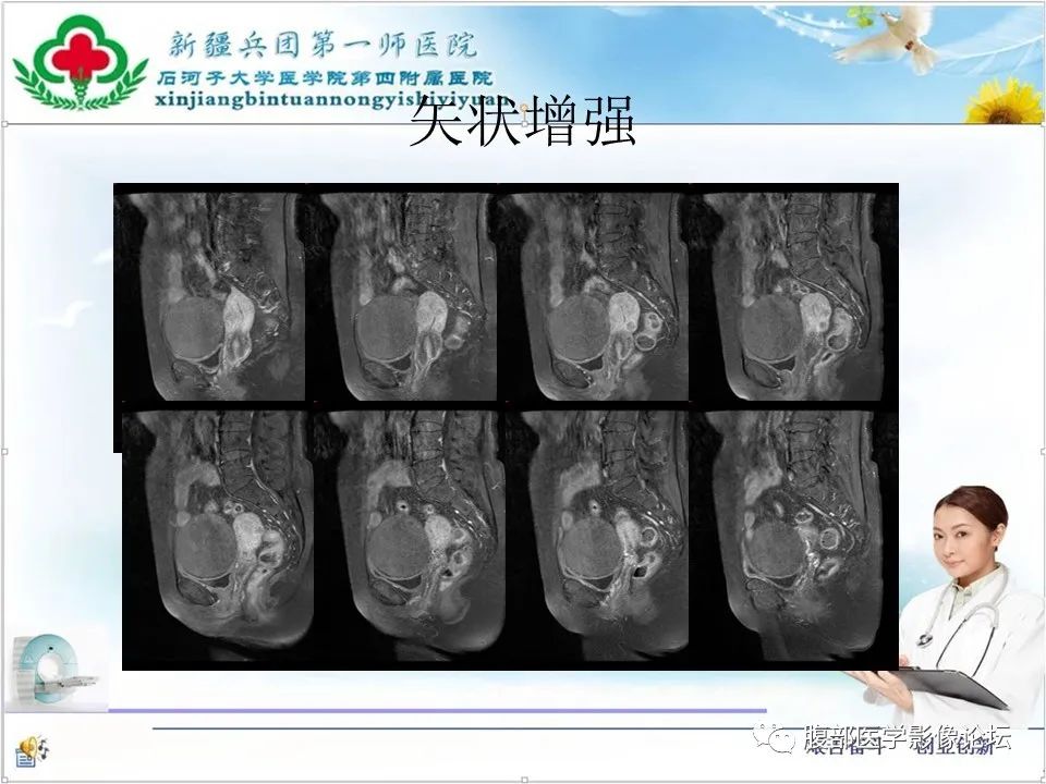 影像PPT - 【病例】卵巢纤维卵泡膜细胞瘤1例CT及MR-15 影像PPT - 【病例】卵巢纤维卵泡膜细胞瘤1例CT及MR-15