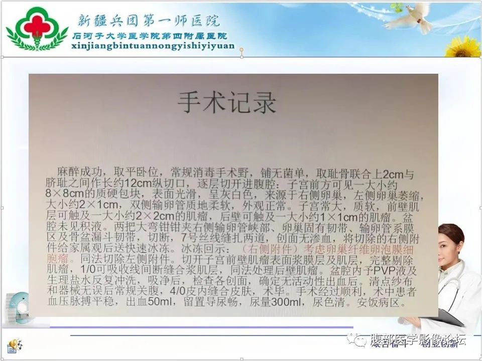 影像PPT - 【病例】卵巢纤维卵泡膜细胞瘤1例CT及MR-17 影像PPT - 【病例】卵巢纤维卵泡膜细胞瘤1例CT及MR-17