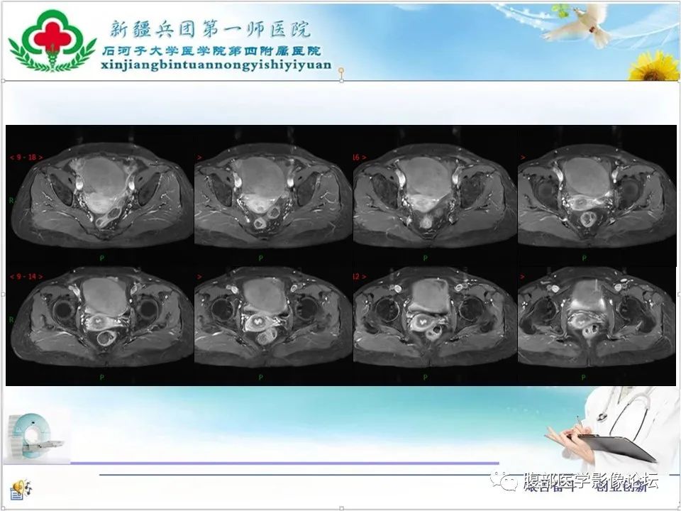 影像PPT - 【病例】卵巢纤维卵泡膜细胞瘤1例CT及MR-14 影像PPT - 【病例】卵巢纤维卵泡膜细胞瘤1例CT及MR-14