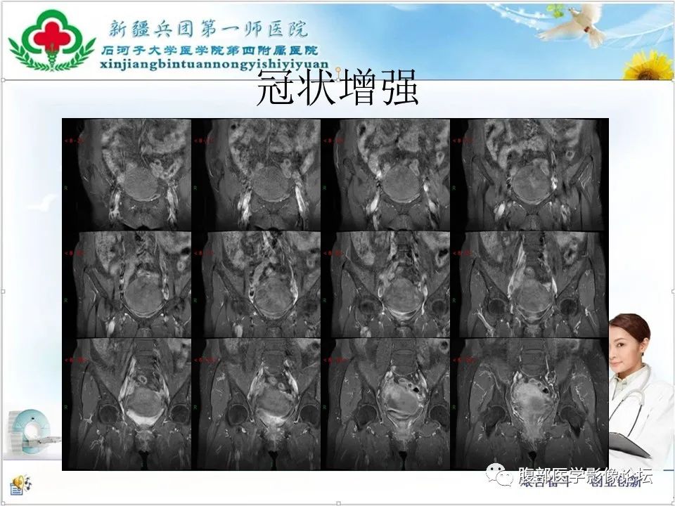 影像PPT - 【病例】卵巢纤维卵泡膜细胞瘤1例CT及MR-16 影像PPT - 【病例】卵巢纤维卵泡膜细胞瘤1例CT及MR-16