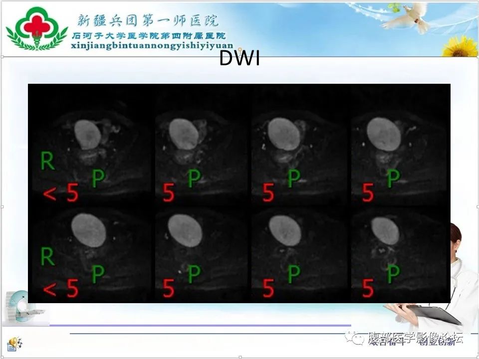 影像PPT - 【病例】卵巢纤维卵泡膜细胞瘤1例CT及MR-1 影像PPT - 【病例】卵巢纤维卵泡膜细胞瘤1例CT及MR-1