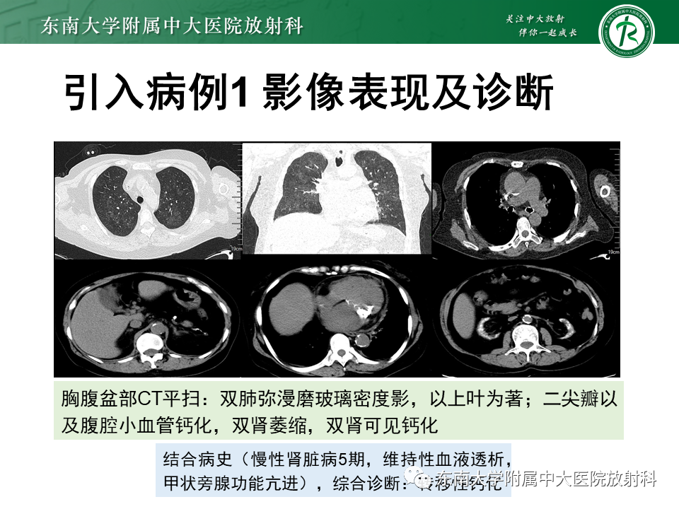 影像PPT - 【PPT】肺转移性钙化影像表现及其鉴别诊断-2 影像PPT - 【PPT】肺转移性钙化影像表现及其鉴别诊断-2
