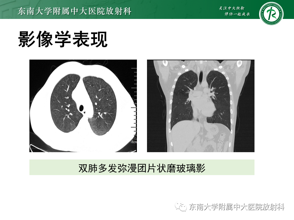 影像PPT - 【PPT】肺转移性钙化影像表现及其鉴别诊断-9 影像PPT - 【PPT】肺转移性钙化影像表现及其鉴别诊断-9