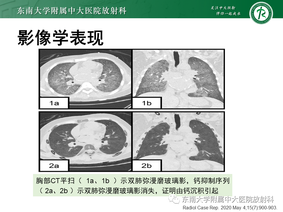 影像PPT - 【PPT】肺转移性钙化影像表现及其鉴别诊断-13 影像PPT - 【PPT】肺转移性钙化影像表现及其鉴别诊断-13