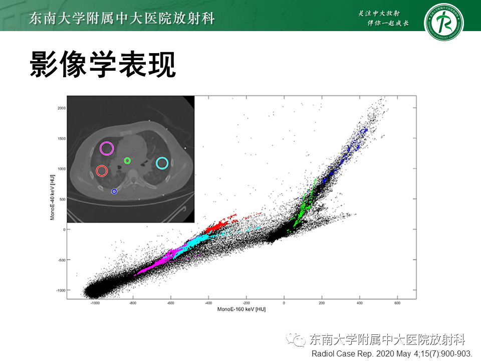 影像PPT - 【PPT】肺转移性钙化影像表现及其鉴别诊断-12 影像PPT - 【PPT】肺转移性钙化影像表现及其鉴别诊断-12