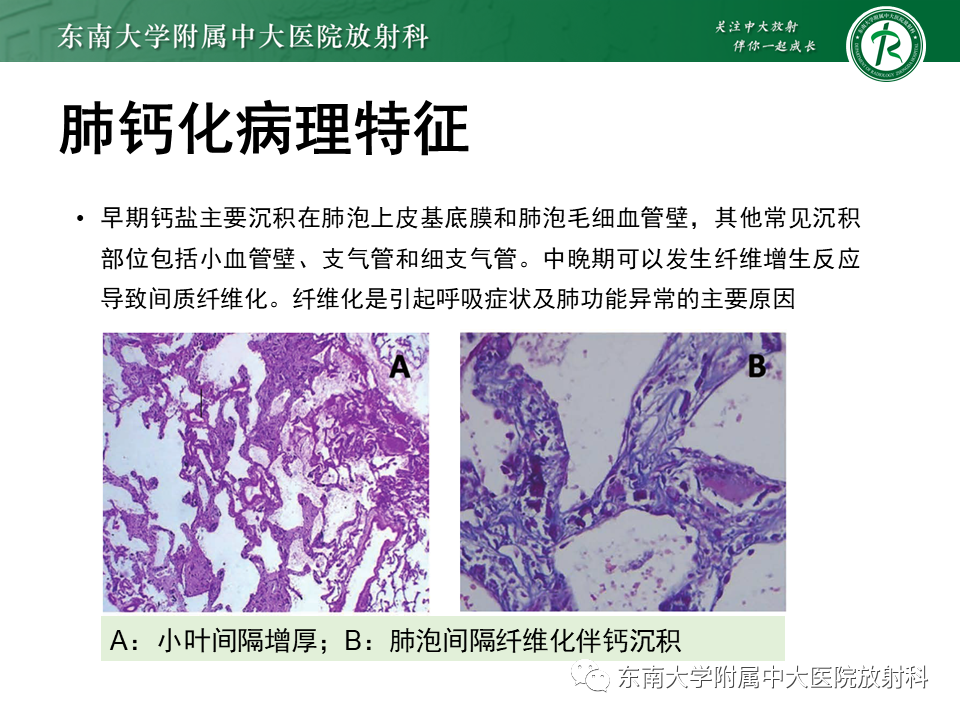 影像PPT - 【PPT】肺转移性钙化影像表现及其鉴别诊断-7 影像PPT - 【PPT】肺转移性钙化影像表现及其鉴别诊断-7