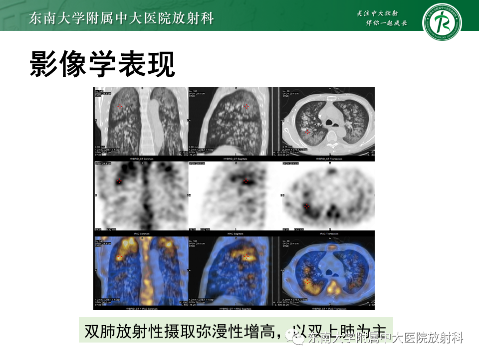 影像PPT - 【PPT】肺转移性钙化影像表现及其鉴别诊断-16 影像PPT - 【PPT】肺转移性钙化影像表现及其鉴别诊断-16