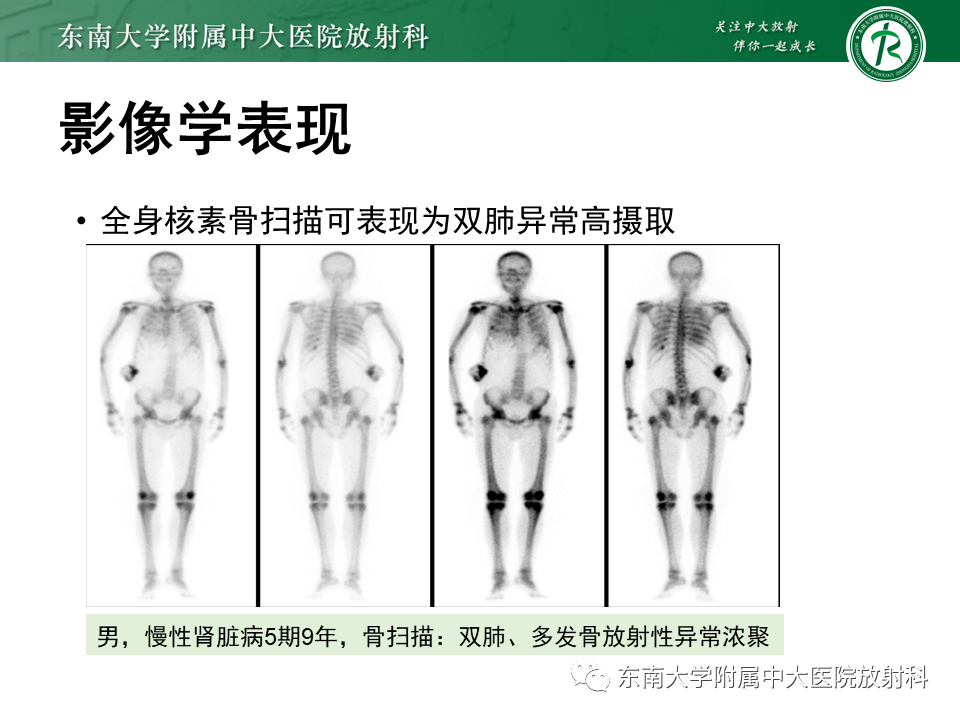 影像PPT - 【PPT】肺转移性钙化影像表现及其鉴别诊断-14 影像PPT - 【PPT】肺转移性钙化影像表现及其鉴别诊断-14