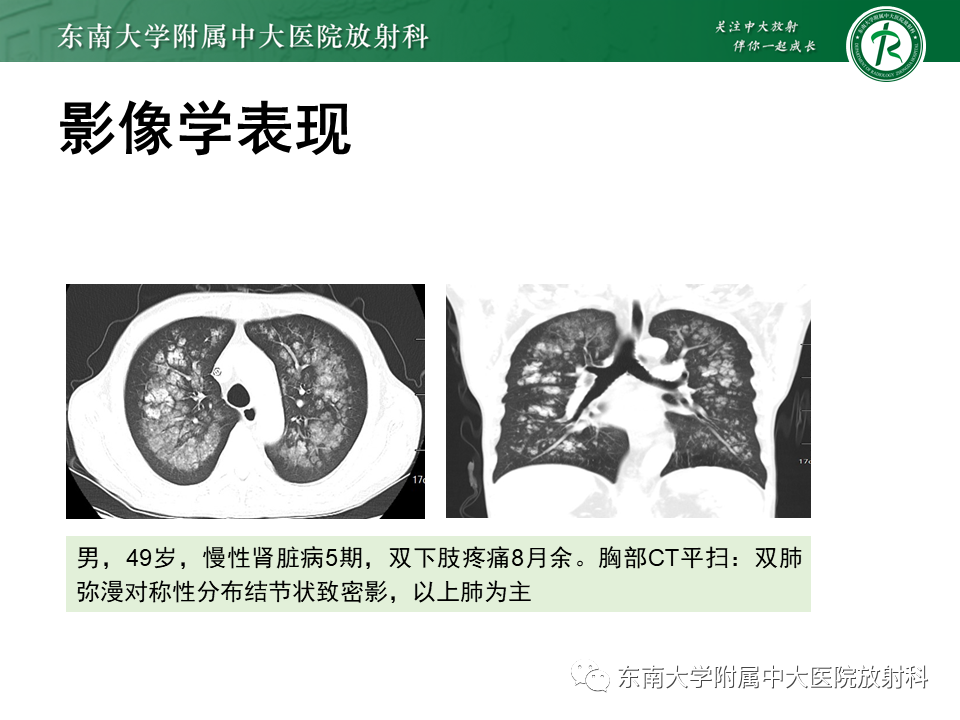 影像PPT - 【PPT】肺转移性钙化影像表现及其鉴别诊断-15 影像PPT - 【PPT】肺转移性钙化影像表现及其鉴别诊断-15