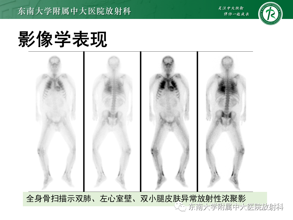 影像PPT - 【PPT】肺转移性钙化影像表现及其鉴别诊断-18 影像PPT - 【PPT】肺转移性钙化影像表现及其鉴别诊断-18
