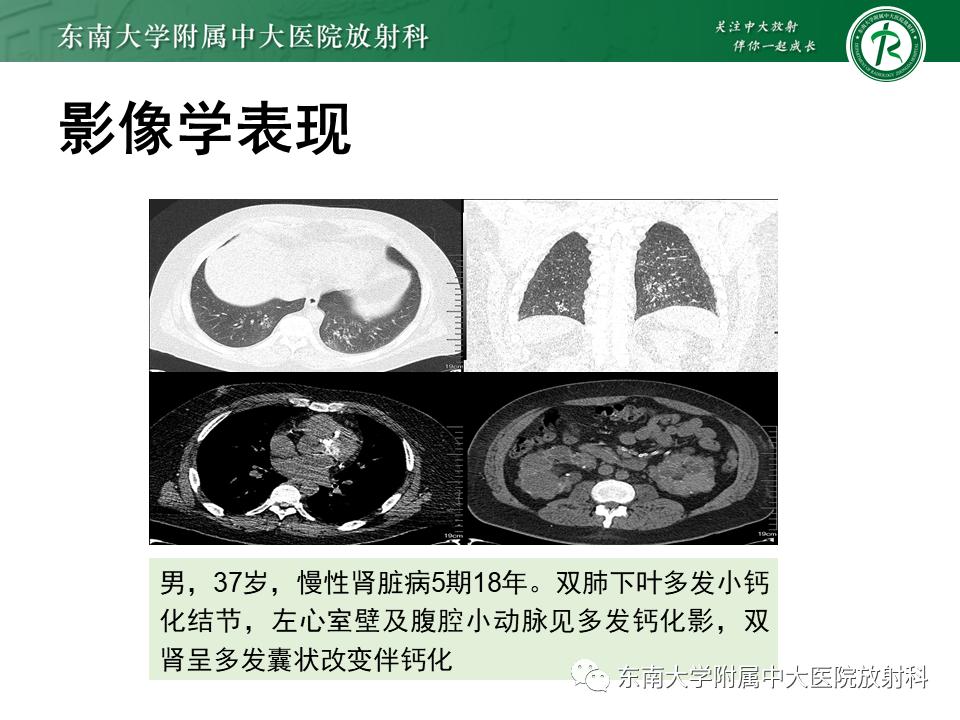 影像PPT - 【PPT】肺转移性钙化影像表现及其鉴别诊断-17 影像PPT - 【PPT】肺转移性钙化影像表现及其鉴别诊断-17