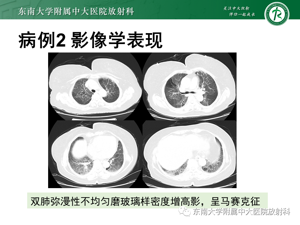 影像PPT - 【PPT】肺转移性钙化影像表现及其鉴别诊断-21 影像PPT - 【PPT】肺转移性钙化影像表现及其鉴别诊断-21