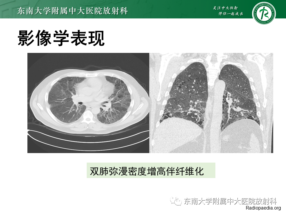 影像PPT - 【PPT】肺转移性钙化影像表现及其鉴别诊断-27 影像PPT - 【PPT】肺转移性钙化影像表现及其鉴别诊断-27