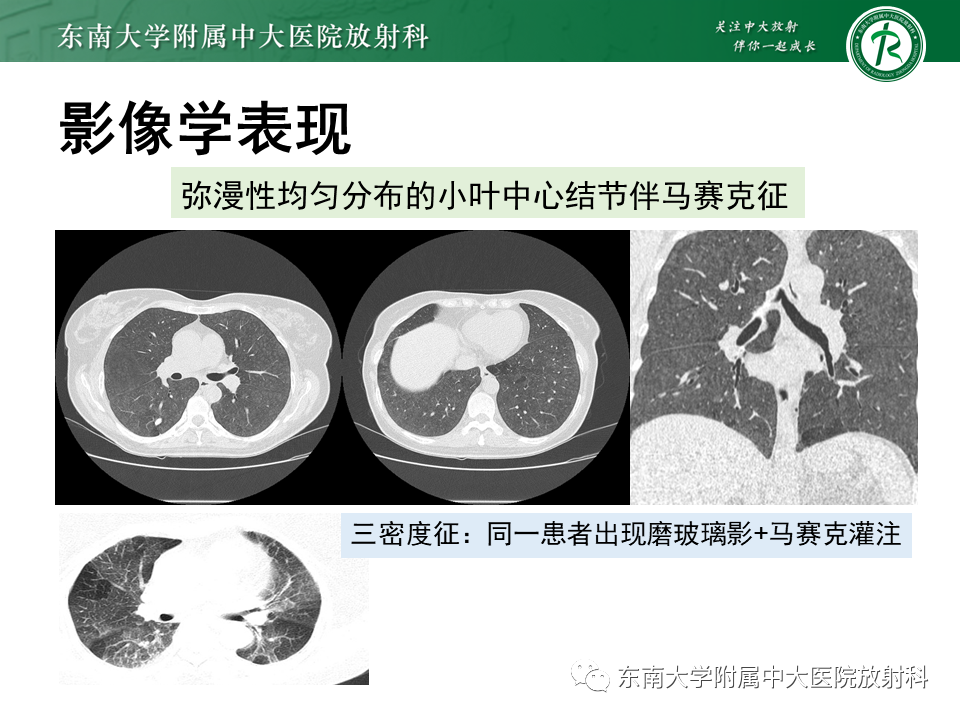 影像PPT - 【PPT】肺转移性钙化影像表现及其鉴别诊断-26 影像PPT - 【PPT】肺转移性钙化影像表现及其鉴别诊断-26