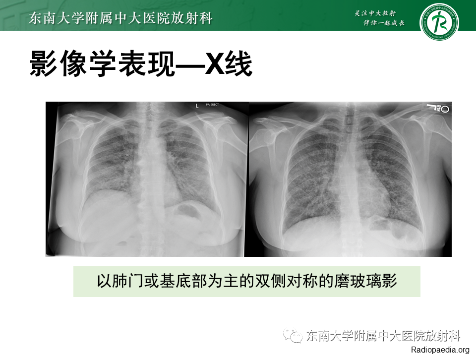 影像PPT - 【PPT】肺转移性钙化影像表现及其鉴别诊断-31 影像PPT - 【PPT】肺转移性钙化影像表现及其鉴别诊断-31