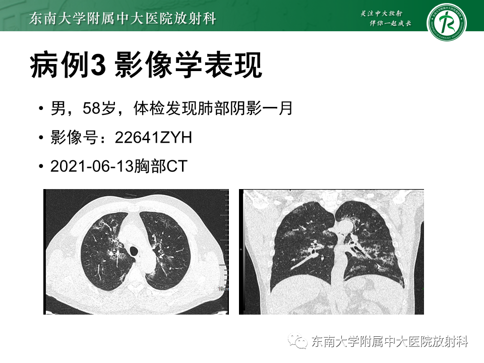 影像PPT - 【PPT】肺转移性钙化影像表现及其鉴别诊断-28 影像PPT - 【PPT】肺转移性钙化影像表现及其鉴别诊断-28
