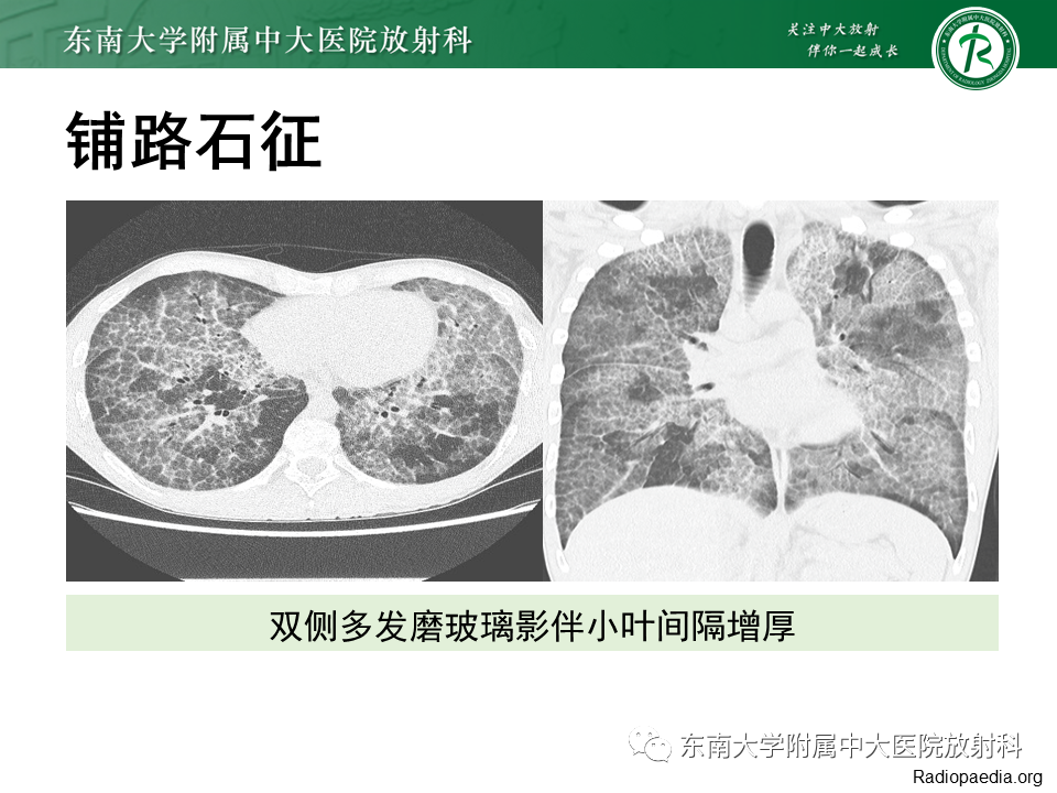 影像PPT - 【PPT】肺转移性钙化影像表现及其鉴别诊断-34 影像PPT - 【PPT】肺转移性钙化影像表现及其鉴别诊断-34