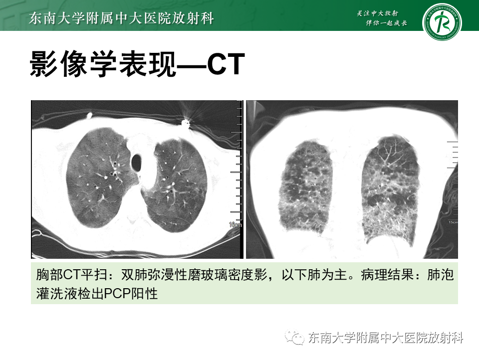 影像PPT - 【PPT】肺转移性钙化影像表现及其鉴别诊断-36 影像PPT - 【PPT】肺转移性钙化影像表现及其鉴别诊断-36