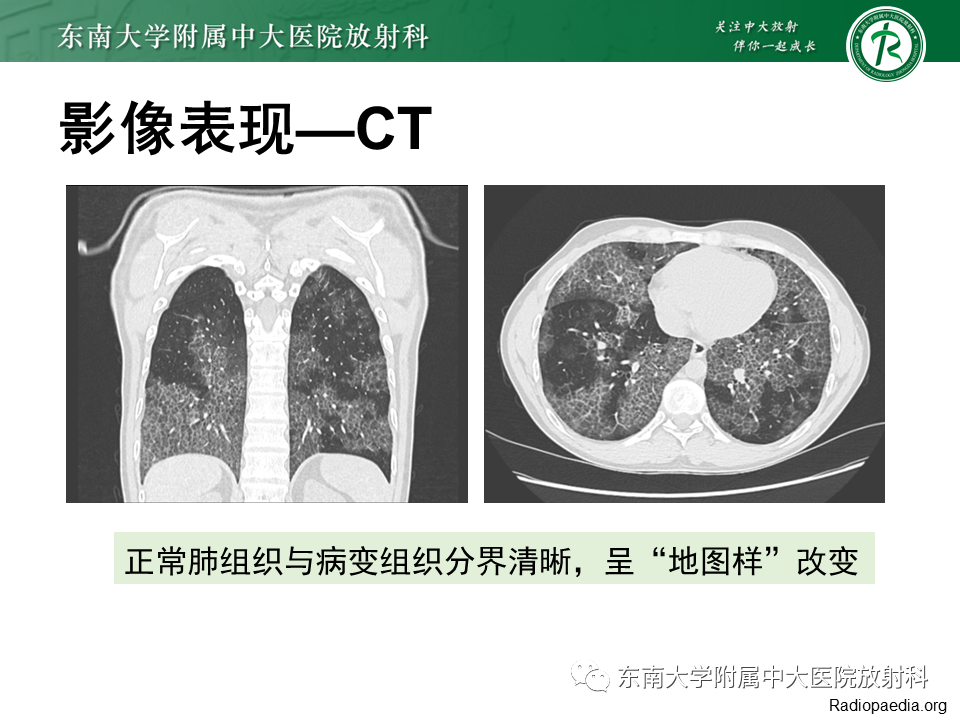 影像PPT - 【PPT】肺转移性钙化影像表现及其鉴别诊断-33 影像PPT - 【PPT】肺转移性钙化影像表现及其鉴别诊断-33