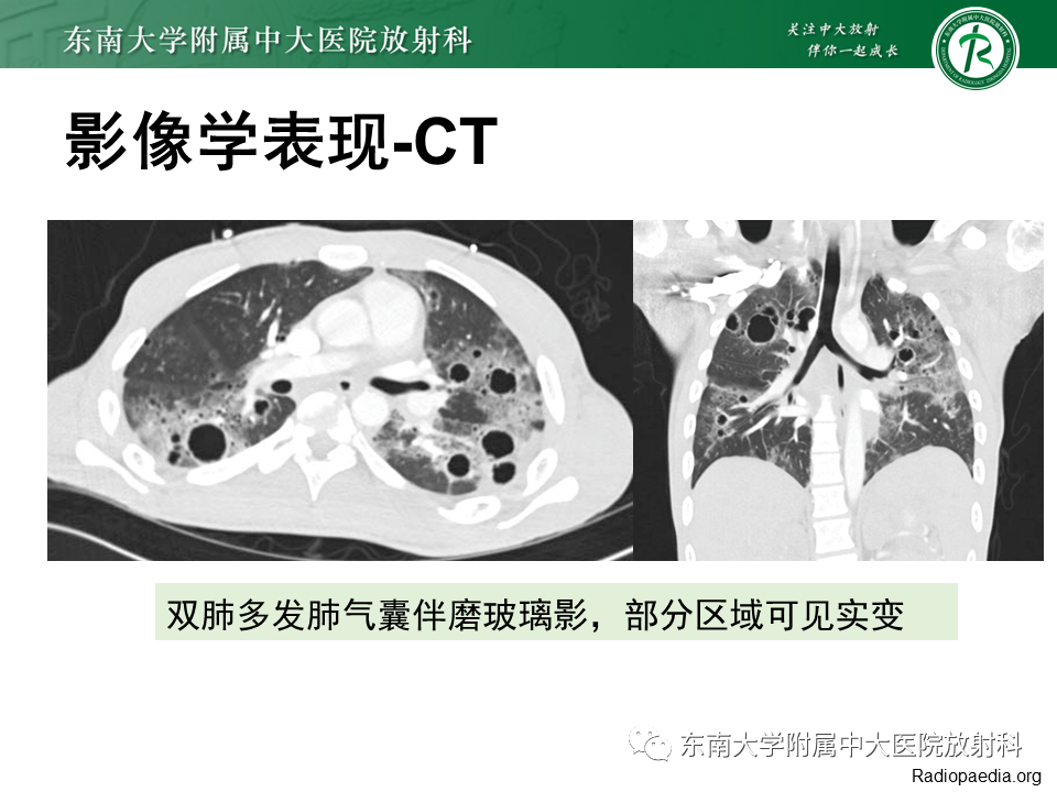 影像PPT - 【PPT】肺转移性钙化影像表现及其鉴别诊断-40 影像PPT - 【PPT】肺转移性钙化影像表现及其鉴别诊断-40