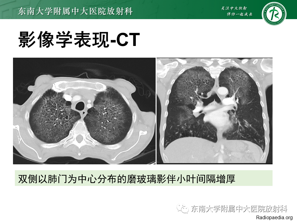 影像PPT - 【PPT】肺转移性钙化影像表现及其鉴别诊断-39 影像PPT - 【PPT】肺转移性钙化影像表现及其鉴别诊断-39