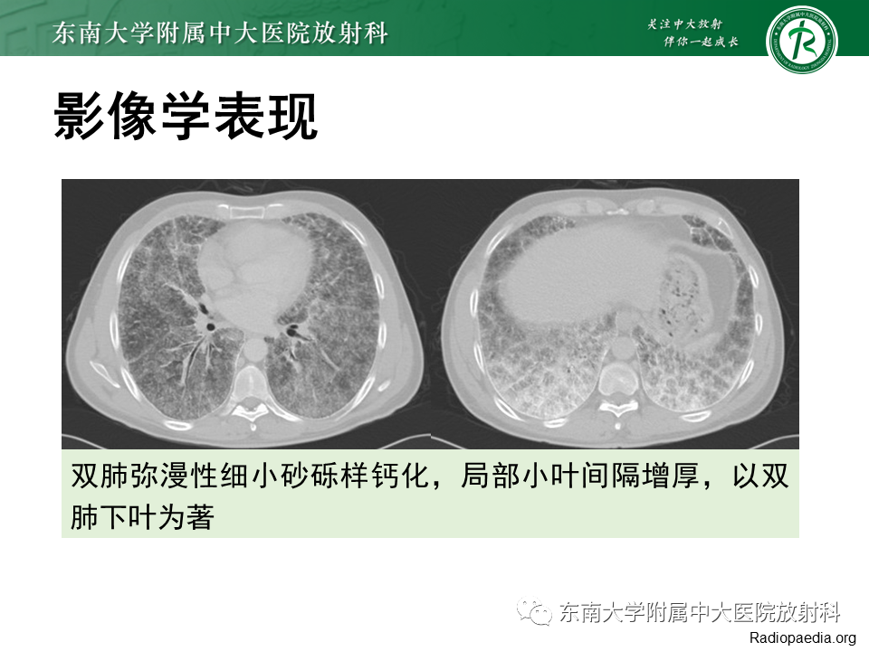 影像PPT - 【PPT】肺转移性钙化影像表现及其鉴别诊断-44 影像PPT - 【PPT】肺转移性钙化影像表现及其鉴别诊断-44