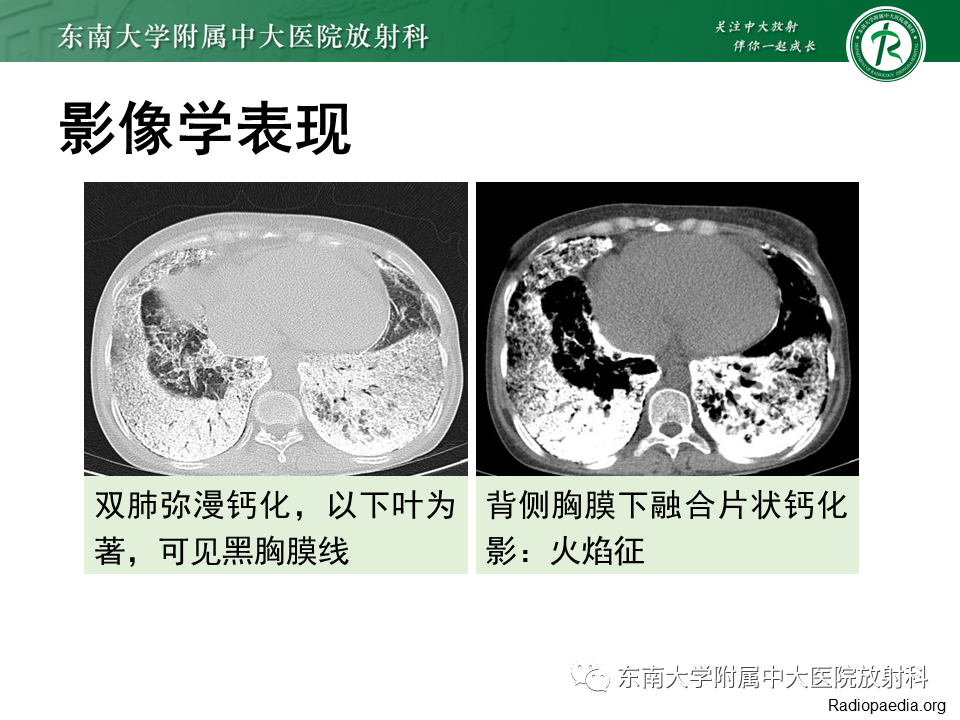 影像PPT - 【PPT】肺转移性钙化影像表现及其鉴别诊断-45 影像PPT - 【PPT】肺转移性钙化影像表现及其鉴别诊断-45