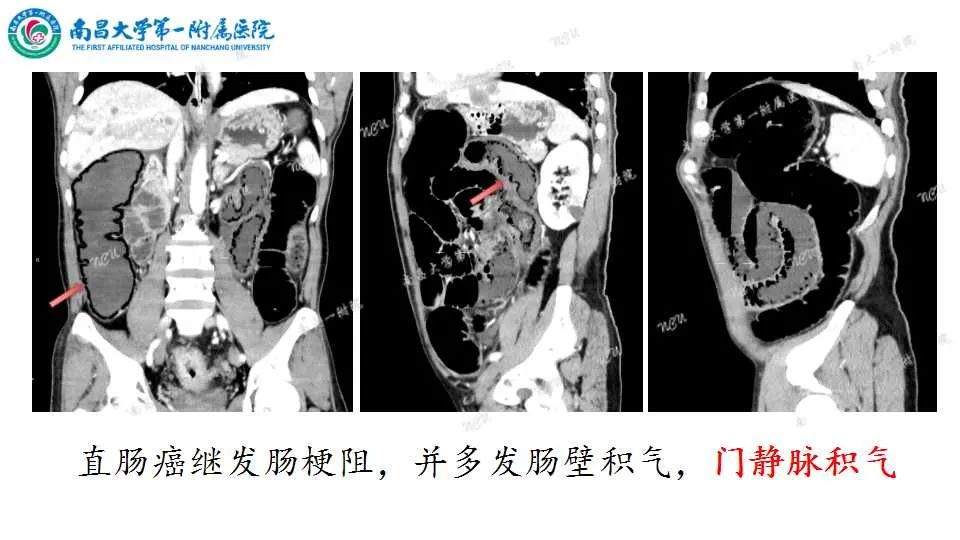 影像PPT - 【PPT】腹部血管性病变急腹症的影像诊断-4