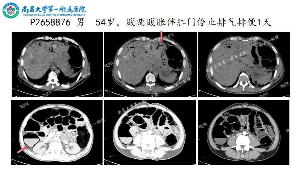 影像PPT - 【PPT】腹部血管性病变急腹症的影像诊断-3