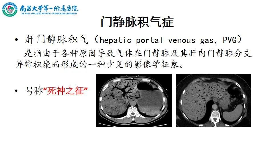 影像PPT - 【PPT】腹部血管性病变急腹症的影像诊断-5