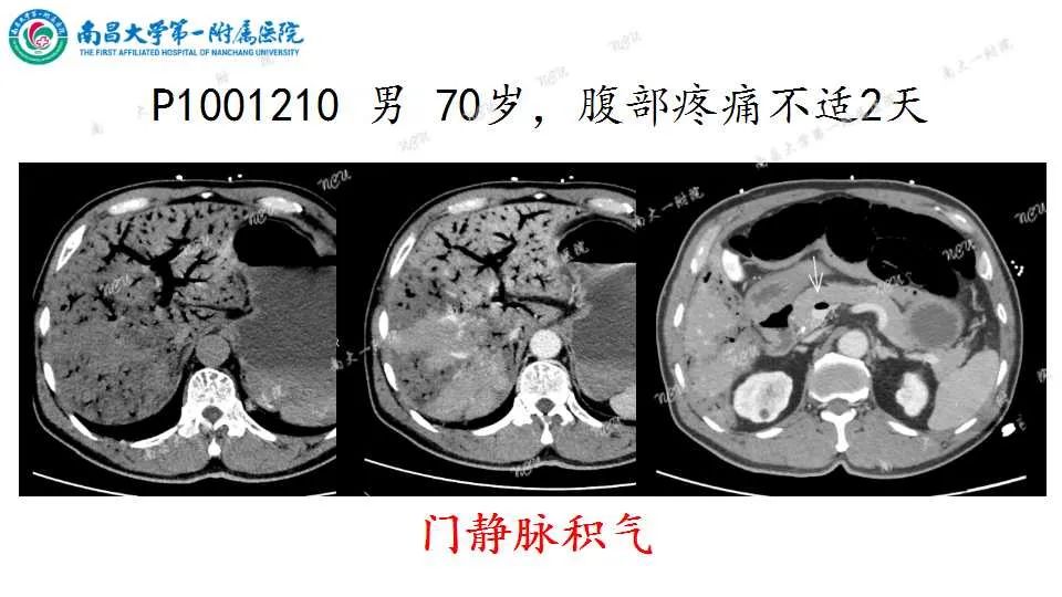 影像PPT - 【PPT】腹部血管性病变急腹症的影像诊断-10