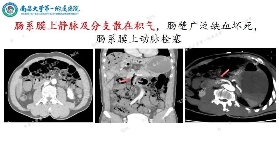 影像PPT - 【PPT】腹部血管性病变急腹症的影像诊断-11