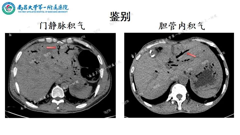 影像PPT - 【PPT】腹部血管性病变急腹症的影像诊断-13