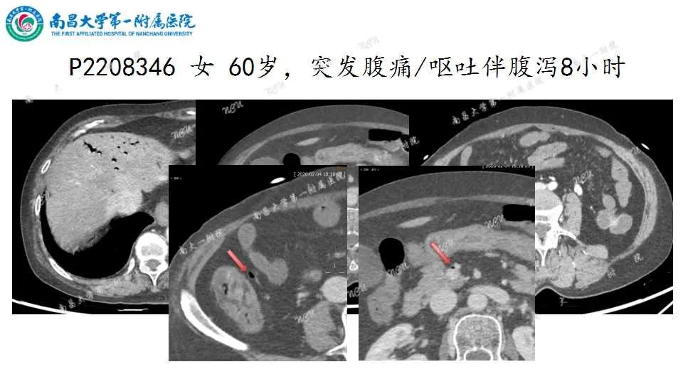 影像PPT - 【PPT】腹部血管性病变急腹症的影像诊断-14