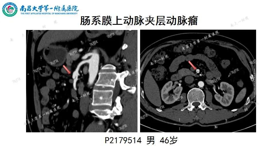 影像PPT - 【PPT】腹部血管性病变急腹症的影像诊断-22