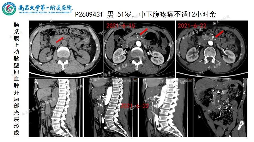 影像PPT - 【PPT】腹部血管性病变急腹症的影像诊断-23