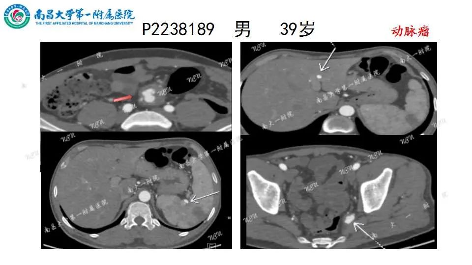 影像PPT - 【PPT】腹部血管性病变急腹症的影像诊断-20